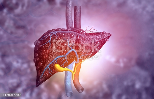 cancer of the liver