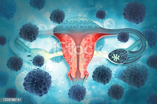 ovarian tumor