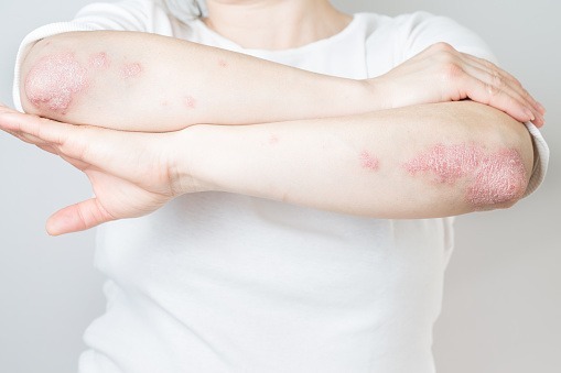 psoriasis