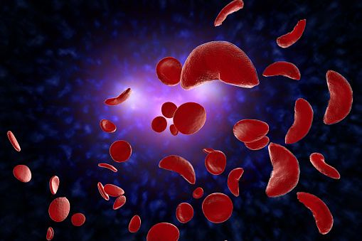 sickle cell crisis
